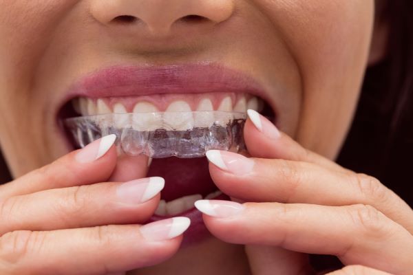 ¿Cómo saber si Invisalign es adecuado para tu tipo de problema dental?